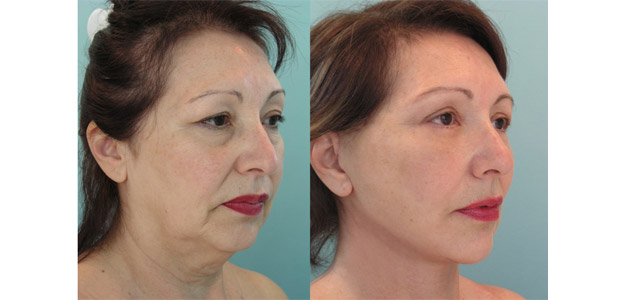 5 Point Face Lift 