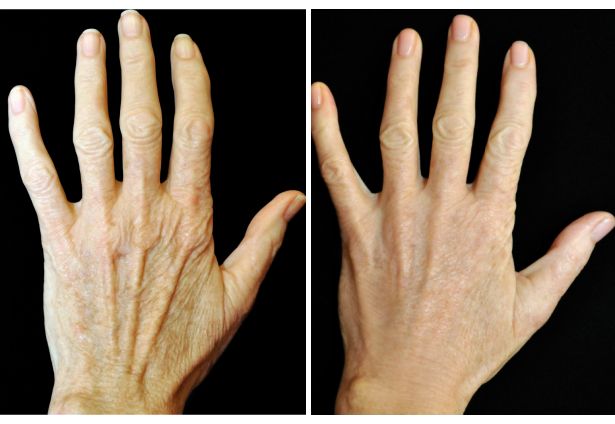 Hand Ageing and Loss of Volume
